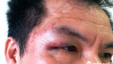 Vùng thái dương, mắt phải của PV Trần Cường bị đánh bầm tím, sưng húp. (Ảnh. NVCC)