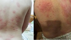 Tình trạng nổi mẩn ngứa sau khi tắm biển khiến người dân bất an