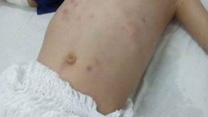 Sau khi bị tình nhân của mẹ bạo hành, cháu L. đang phải điều trị tại bệnh viện với những vết thương trên khắp cơ thể