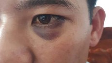 Vết bầm tím trên mắt của thầy giáo Bảo.