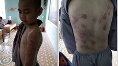 Hình ảnh các vết thương tích trên cơ thể cháu Dĩnh do cô giáo chủ nhiệm (Ảnh do cô Phạm Thị Nhuần cung cấp cho PV)