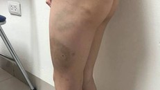 Vết bầm tím chằng chịt trên cơ thể bé trai.