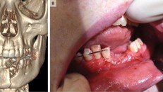 Vì hút thuốc lá điện tử, cậu bé 17 tuổi xảy ra tai nạn đáng tiếc