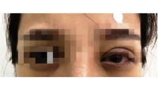 Đôi mắt cô gái viêm nhiễm, sưng vù sau nhấn mí không đảm bảo an toàn.