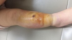 Tổn thương ở chân bé T. sưng nóng, đỏ kèm mụn mủ.