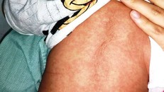 Điều trị cho bệnh nhi mắc sởi tại BVĐK Nông nghiệp.