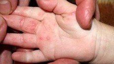 Chuyên gia chỉ cách nhận diện bệnh tay chân miệng ở trẻ em qua các giai đoạn