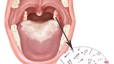 Bệnh bạch hầu có thể gây hậu quả nghiêm trọng nếu không được phát hiện và điều trị kịp thời.