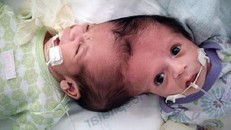 Kỳ lạ những cặp song sinh dính liền sống rất lâu dù không mổ tách