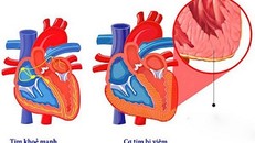 COVID-19 có thể ảnh hưởng đến tim.