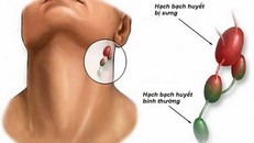 Một số bệnh nhiễm trùng cấp tính thường có hạch xuất hiện gần vùng tổn thương.