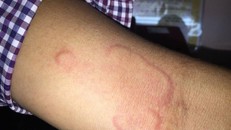 Khi nào cần xét nghiệm ký sinh trùng?