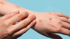 Bệnh đậu mùa khỉ không còn là tình trạng khẩn cấp y tế toàn cầu