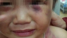 Bình Thuận: Bé 3 tuổi bị cha dượng đánh bất tỉnh chỉ vì 1 câu nói