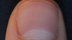 Móng tay có hình trăng lưỡi liềm: Dấu hiệu bệnh tật