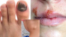 Dấu hiệu rõ rệt cho thấy bạn đã nhiễm HIV