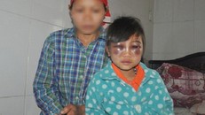 Lào Cai buộc thôi việc giáo viên đánh học sinh tím mặt