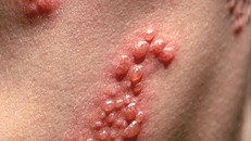 Chữa zona thần kinh chỉ vài ngày là khỏi không cần thuốc tây