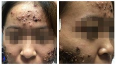 Gương mặt của cô gái sau khi trị trứng cá tại một phòng khám tư