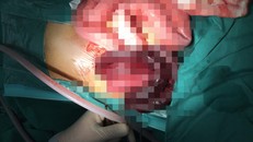 Người đàn ông hoại tử 1 mét ruột