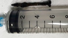 Cây đinh sắt đã gỉ được gắp ra từ phổi bệnh nhân.