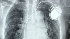 Chiếc máy tạo nhịp tim đặt trong cơ thể cụ bà - Ảnh: Vnexpress