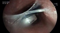Hình ảnh dị vật mắc trong thực quản bệnh nhân