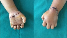 Hình ảnh bàn tay bệnh nhân trước khi xuất viện.