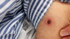 Vết đốt ở bệnh nhân sốt mò.