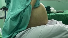 Phần bụng nữ bệnh nhân to khổng lồ vì khối u buồng trứng.