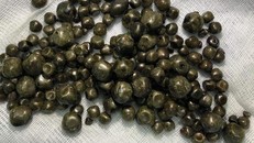 300 viên sỏi trong túi mật của bệnh nhân suốt 10 năm.