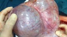 Khối u nang buồng trứng "khủng" được lấy ra từ trong bụng bệnh nhân.
