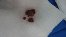 Mẩu xương heo khi được gắp ra khỏi cơ thể bệnh nhân.