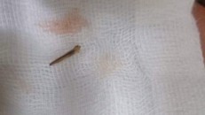 Dị vật là đầu gai cây dại còn sót lại trong chân bé trai 10 tuổi