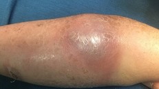 Cẳng tay sưng nề, tấy đỏ của bé M. sau một tháng đắp thuốc lá chữa gãy xương. 