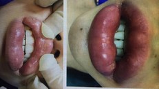 Kinh hoàng làm đẹp bằng filler