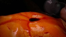 Phẫu thuật trả lại ngực cho 2 trẻ bị lõm ngực nặng