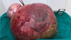 Khối u khổng lồ nặng 5kg
