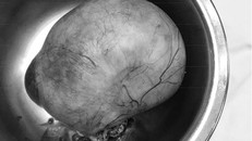 Khối u khủng khiến người phụ nữ nhập viện khẩn cấp - Ảnh: VietNamNet