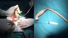 Dị vật được lấy ra dài 45cm - Ảnh: VietNamNet