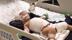 Bị ấm nước sôi ập thẳng vào người, bé gái bị bỏng thương tâm