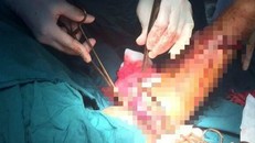 Cấp cứu ngư dân bị cá lớn cắn đứt bàn tay