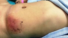 Mẹ tự ý dán cao chữa mụn khiến con phải nhập viện cấp cứu