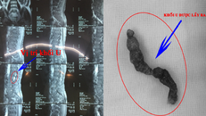 Khối U nằm trong tủy sống bệnh nhân - Ảnh: VTC News
