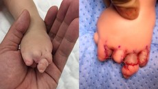 Hình ảnh các ngón tay của bệnh nhi trước và sau can thiệp - Ảnh: VTV