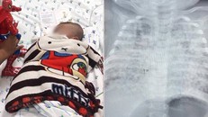 Bị nhiễm lao kê cực nặng, bé 3 tháng tuổi sống sót thần kỳ