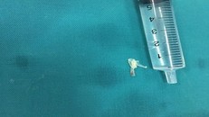 Dị vật là xương cá được lấy ra từ khí quản bé 10 tháng tuổi - Ảnh: Lao Động