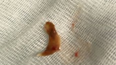 Dị vật được lấy ra là một mảnh xương vịt - Ảnh: Lao Động