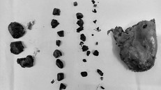 Sỏi và túi mật được cắt của bệnh nhân - Ảnh: VTV