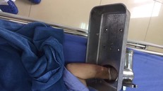 Người phụ nữ cấp cứu với bàn tay nằm trong máy xay thịt